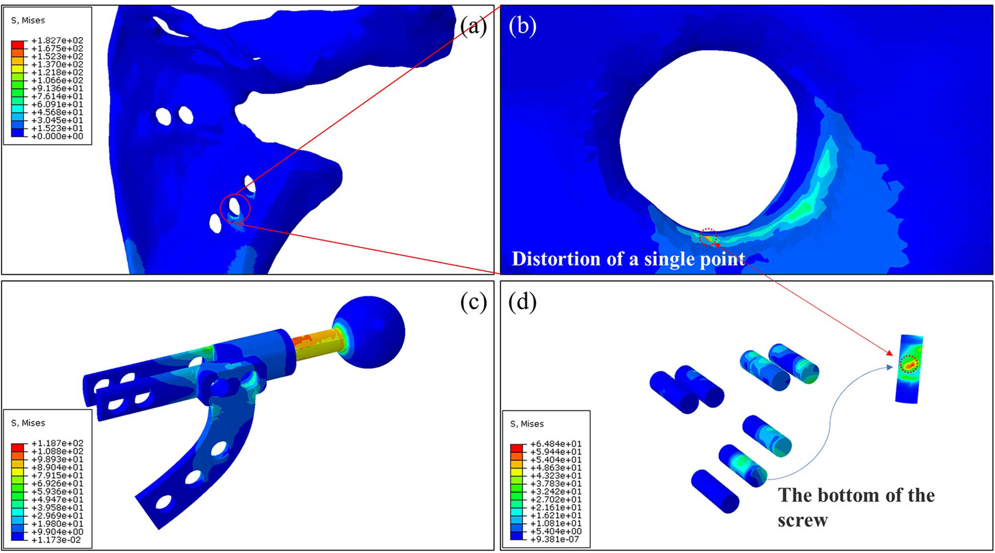 Figure 4 
                  Finite element analysis results after implantation of personalized prosthesis: (a) stress cloud diagram of the scapula after implantation of personalized prosthesis; (b) enlarged view of a screw hole; (c) stress cloud diagram of the implanted personalized prosthesis; and (d) stress cloud diagram of screws.
               