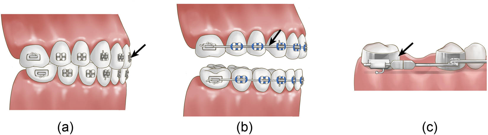 Figure 2 
               (a) Orthodontic stainless-steel brackets; (b) orthodontic metal archwires; and (c) orthodontic stainless-steel bands (black arrow points).
            