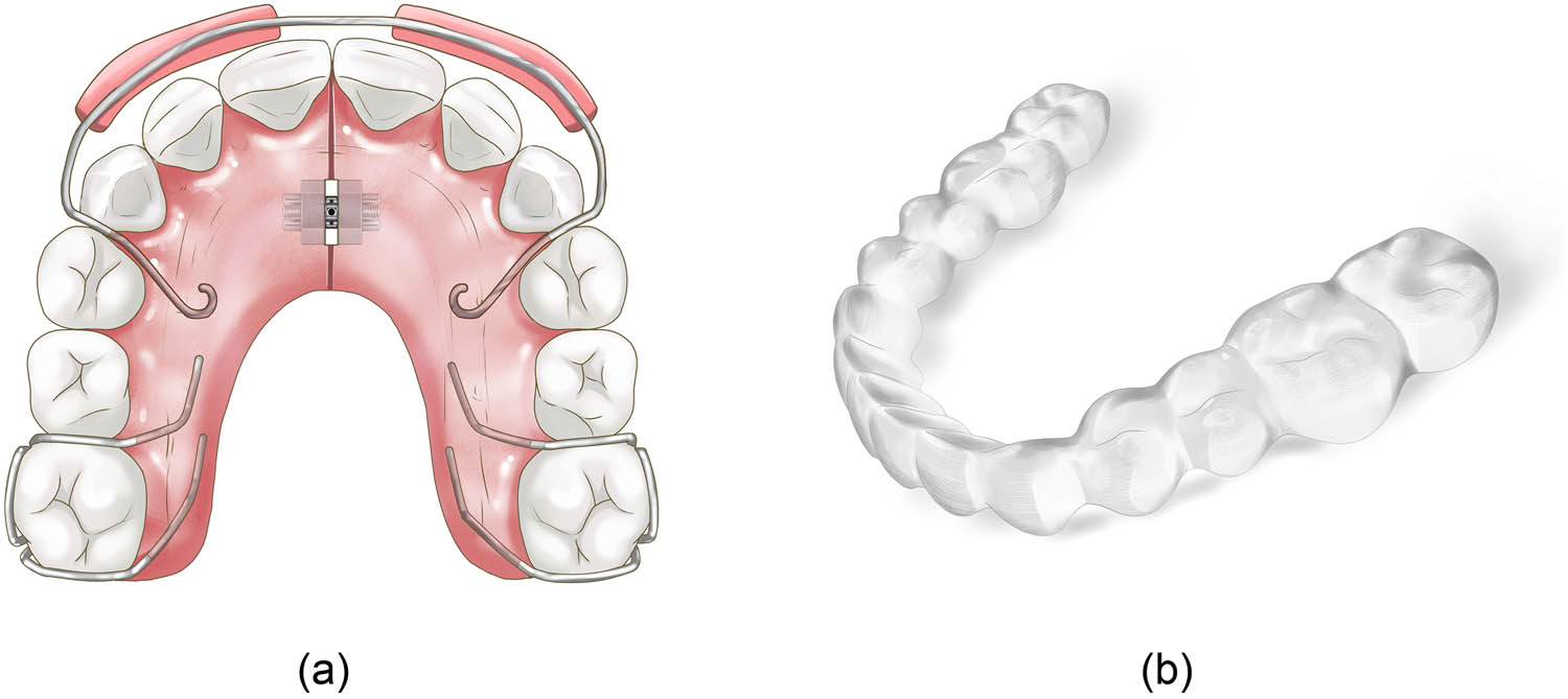 Figure 3 
                     (a) Traditional removable orthodontic appliances and (b) clear aligner.
                  
