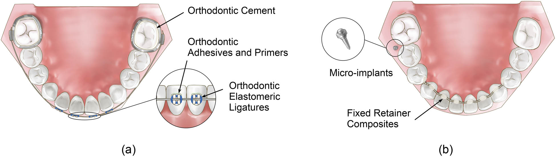 Figure 4 
                     (a and b) Orthodontic auxiliaries.
                  