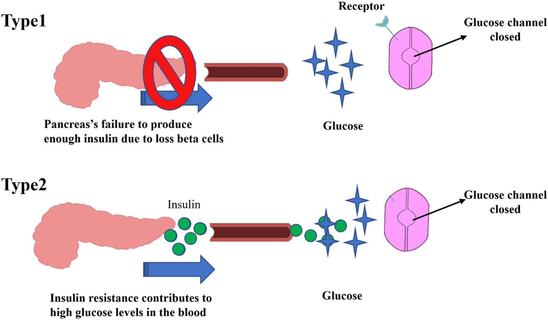 Figure 1 
                  Schematic presentation of insulin fate in T1DM and T2DM.
               