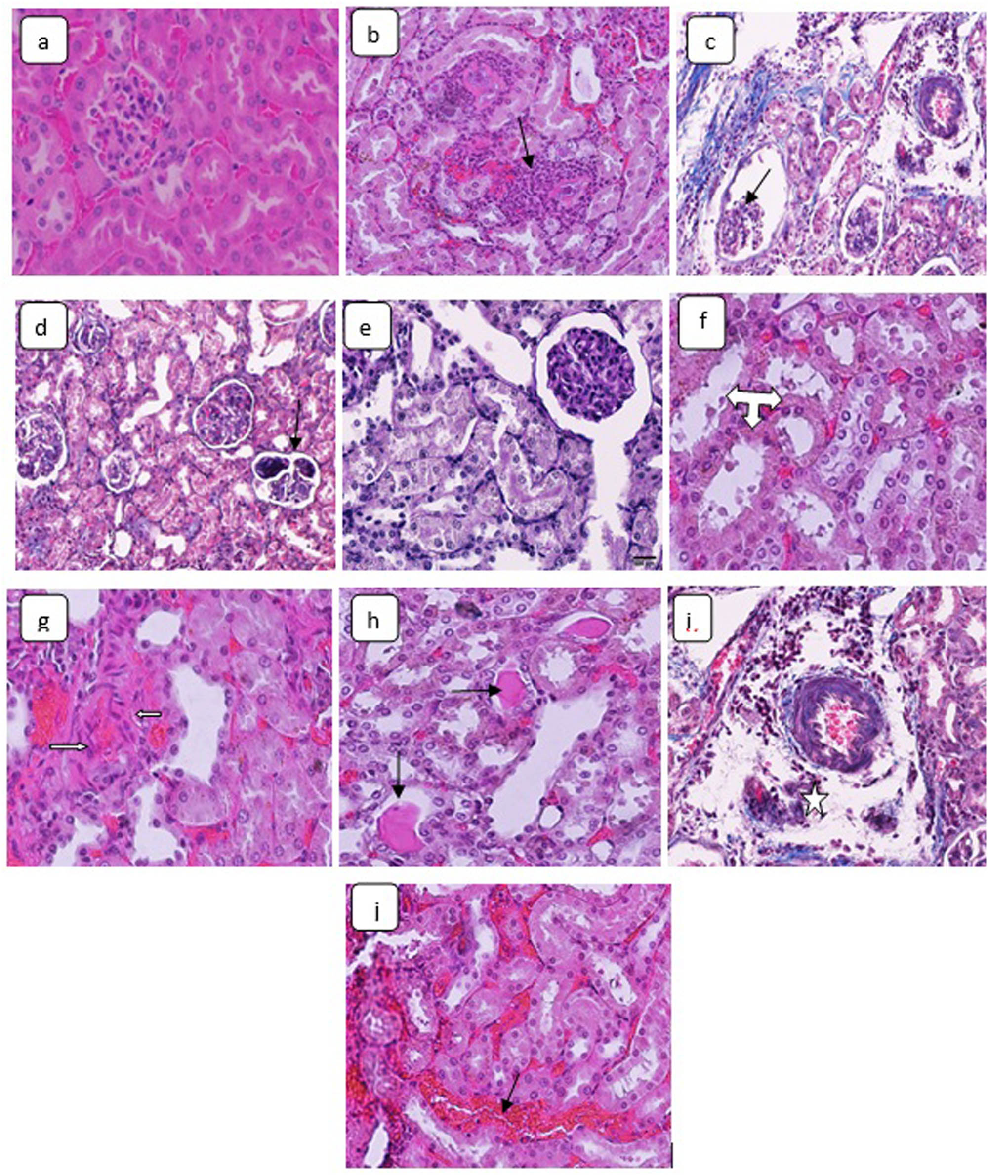 Figure 2
H&E stained sections in the kidneys demonstrating (a) control animal renal tissue, ×160. Kidney sections of CuO NPs-treated rats showing: (b) inflammatory cells inflammation (arrow), ×160; (c) glomerular atrophy (arrow), ×160; (d) glomerular fragmentation (arrow), ×160; (e) tubules necrosis, ×320; (f) tubules hydropic degeneration (triple headed arrow), ×480; (g) fibrocytes proliferation (arrows), ×160; (h) hyaline casts precipitation (arrows), ×160; (i) interstitial edema (star), ×160; and (j) renal congestion (arrow), ×160.
