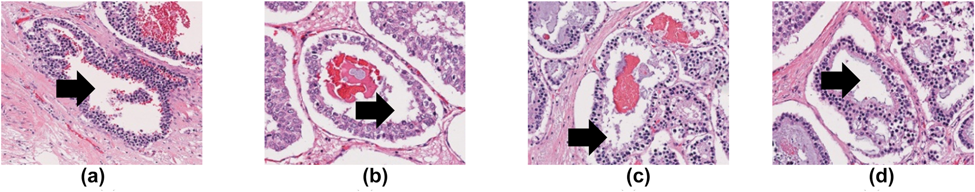 Figure 3: 
The central lumen of the tubule in different breast histopathological images are shown by the black arrows.