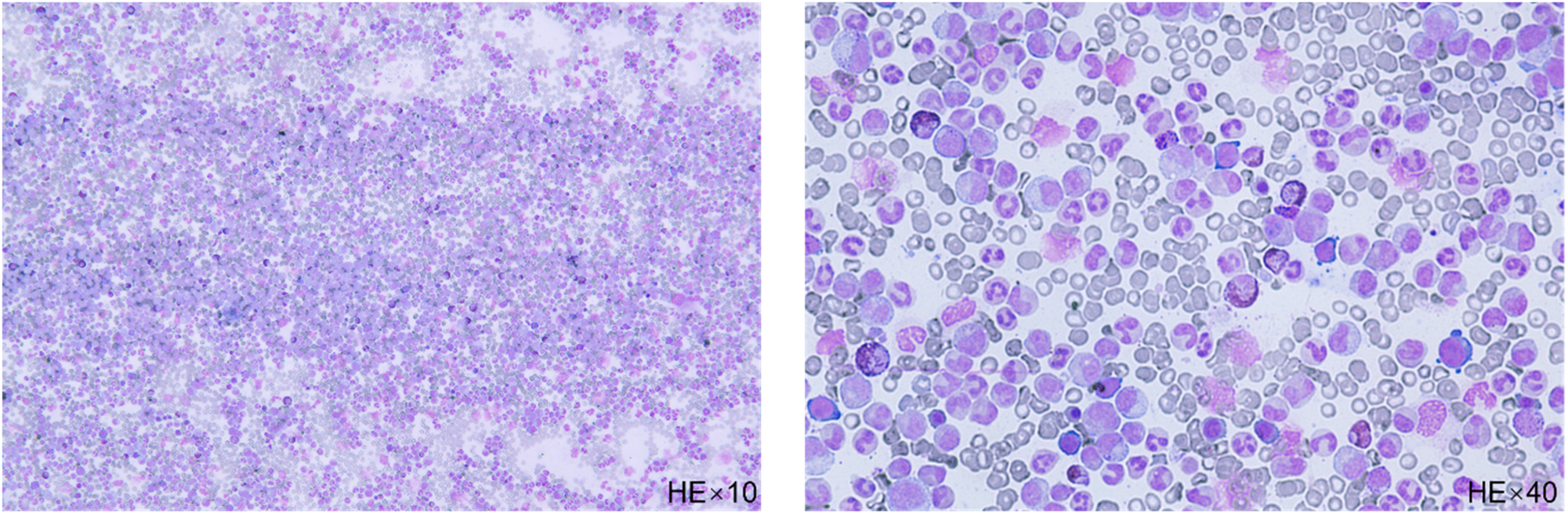 Figure 1: 
The bone marrow smear shows nucleated cell proliferation extremely active, late neutrophils, and rod nucleated cells are the most common, their cytosol size varies and the nucleoplasmic development is unbalanced (HE stain).
