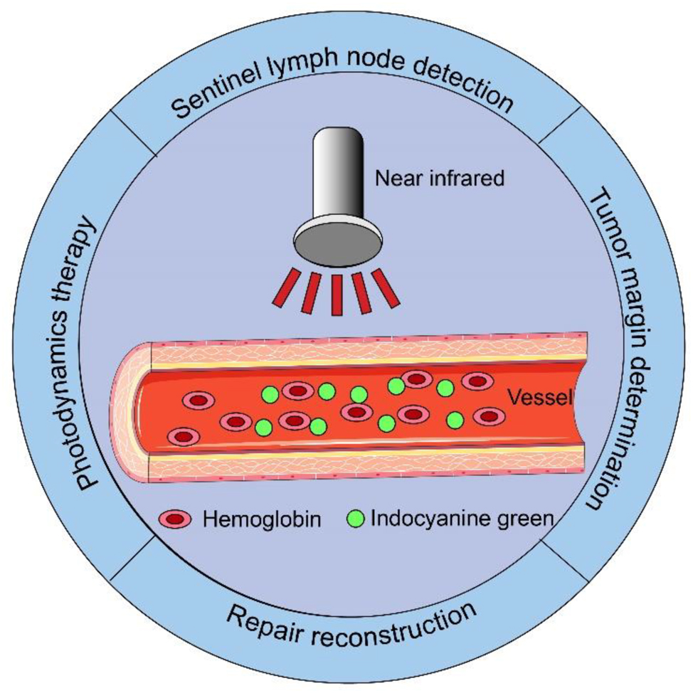Figure 1: 
Application of indocyanine green in oral cancer.
