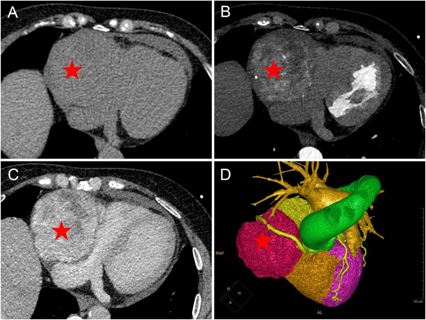 Figure 2: 
Chest CT and coronary CTA findings of PGL. (A–C) Chest CT. A large mass similar in density to the liver (red pentagram) was seen adjacent to the right side of the heart, which was not clearly delineated from the right atrium and ventricle. CT attenuation was 34 Hounsfield units (HU) on non-enhanced CT ((A) non-enhanced CT). After contrast administration, the mass (red pentagram) was continuously and heterogeneously enhanced (B) arterial phase; (C) venous phase. (D) Volume rendering showed that the mass was partially surrounded by the right coronary artery, which was moderately displaced by the mass.
