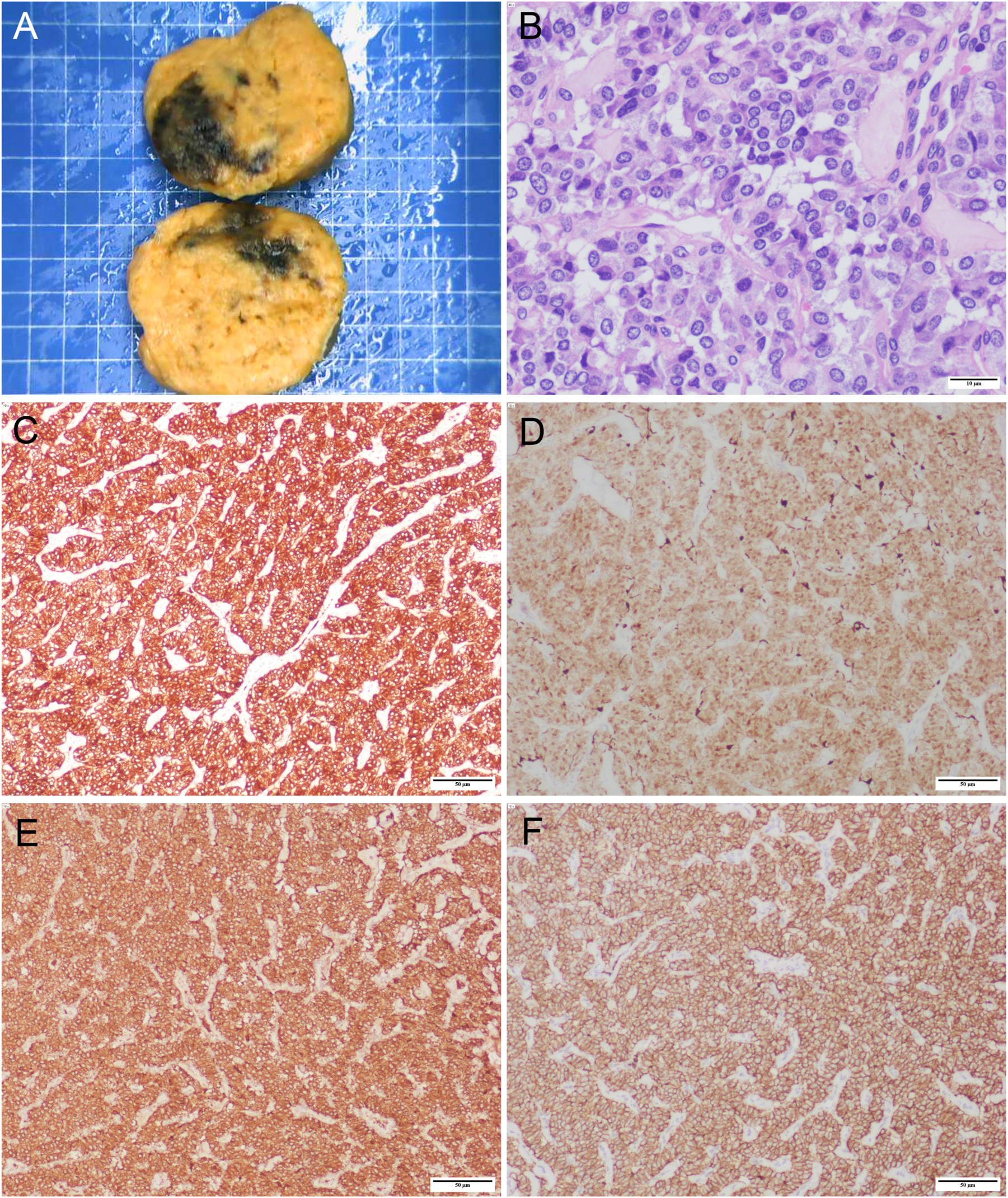 Figure 4: 
Final pathology slide of PGL specimen. (A) Surgical specimen (size: 7 cm×6 cm×6 cm). (B) Hematoxylin and eosin staining of paraganglioma (×400), scale bar: 10 μm. Immunohistochemistry results: (C) Synaptophysin (×100); (D) S-100 (×100); (E) Chromogranin A (×100); (F) CD56 (×100). Scale bar: 50 μm.
