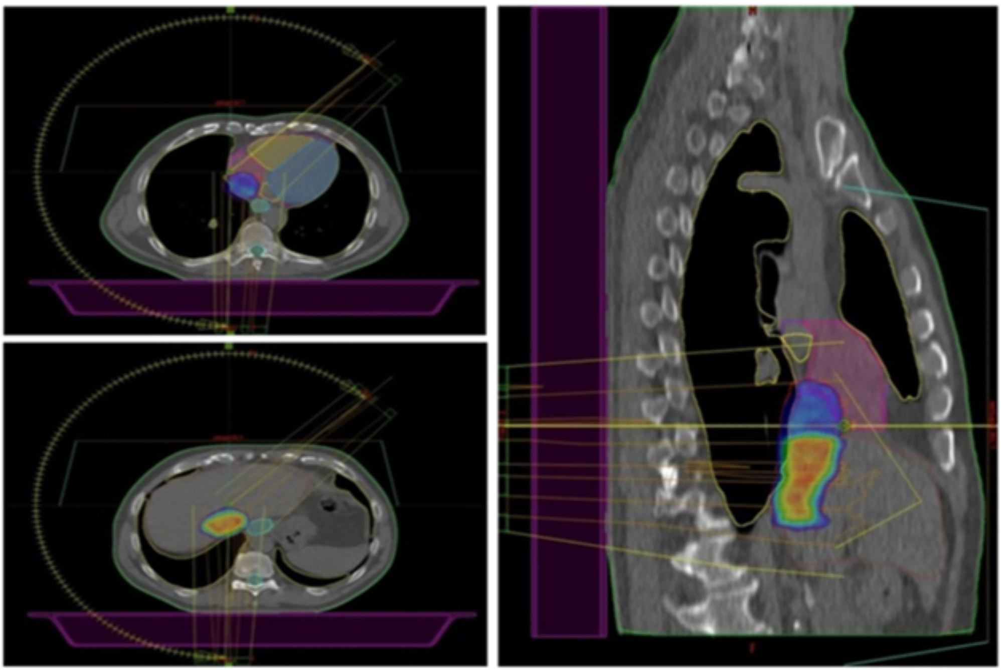 Figure 1: 
Axial (on the left) and sagittal (on the right) planes showing the 98 % dose distribution. Two prescription dose levels are depicted: the hotter yellowish/reddish dose color-wash refers to the highest dose prescription (40 Gy to the SIB volume), which gradually fades into the colder bluish lower dose (32.5 Gy) to the longitudinal section of the TT closer to the heart to reduce the risk of cardiac toxicity.
