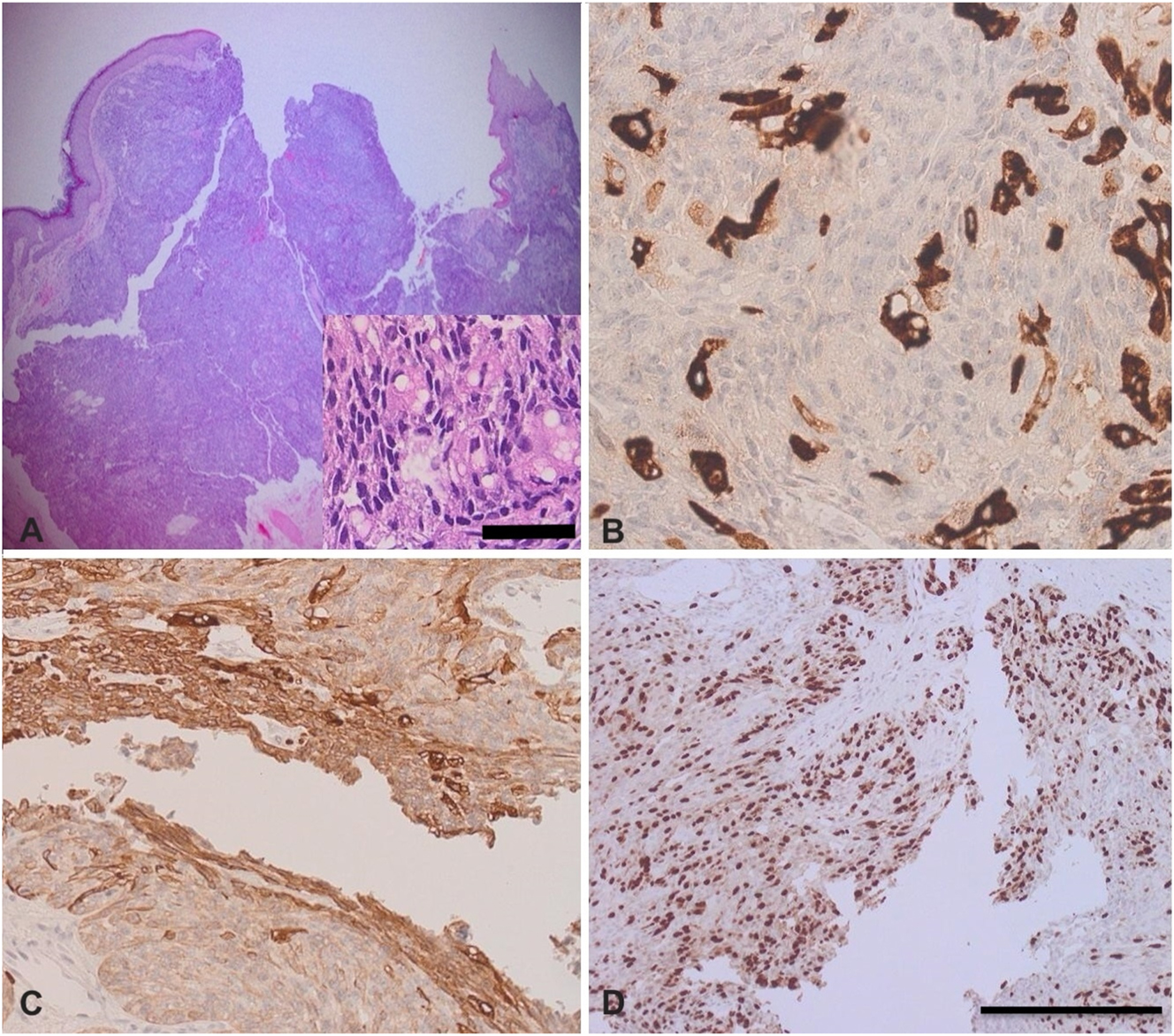 Figure 1:
The histological features of sebaceous carcinoma (SC). (A, B) H&E-stained sections showing a dermal-based malignant sebocytic neoplasm arranged in nodules and sheets-like pattern; (B) SC with cytokeratin stain; (C) SC with epithelial membrane antigen (EMA) stain; (D) SC with Ki-67 proliferative index shows high proliferation rate. This is an original image provided by the corresponding author (Yousef Katib) (scale bar for the inserted image=25 μm, scale bar for other images=40 μm).