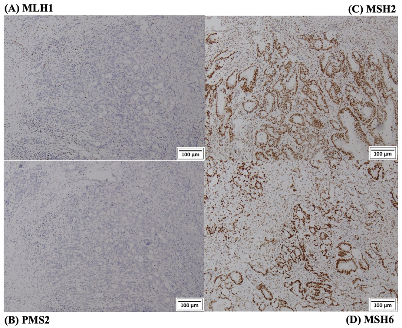 Figure 3: 
IHC staining images from a patient loss of expression of MLH1 and PMS2 proteins. (A) Loss of expression of MLH1 protein; (B) loss of expression of PMS2 protein; (C) normal expression of MSH2 protein; (D) normal expression of MSH6 protein.
