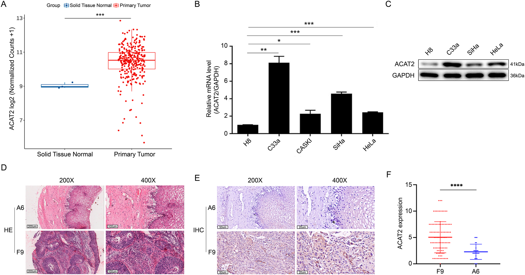 Figure 1: 
The expression of ACAT2 in cervical cancer and normal tissue or cell lines. (A) RNA-seq counts data of squamous carcinoma of the cervix and human normal tissue specimens from the TCGA, GEO, and oncomine databases were normalized to compare expression levels. (B) Quantitative polymerase chain reaction (qPCR) analysis of ACAT2 relative expression in human cervical cancer cell lines C-33A, CASKI, SiHa, and HeLa compared to human immortalized cervical epithelial H8 cells. GAPDH was used as the internal reference gene. (C) ACAT2 protein expression levels were assessed by western blotting in human cervical epithelial cell line H8 and the human cervical cancer cell lines C-33A, SiHa, and HeLa. (D) HE staining in cervical cancer tissues (sample F9) is more intense than in adjacent noncancerous tissues (sample A6). Representative images at 200× and 400× magnifications are shown. Scale bar, 200 and 100 μm. (E) ACAT2 staining in cervical cancer tissues (sample F9) is stronger than in adjacent noncancerous tissues (sample A6). Representative IHC images at 200× and 400× magnifications are shown. Scale bar, 50 and 20 μm. (F) Corresponding statistical analyses for IHC. *p<0.05, **p<0.01, ***p<0.001, ****p<0.0001.

