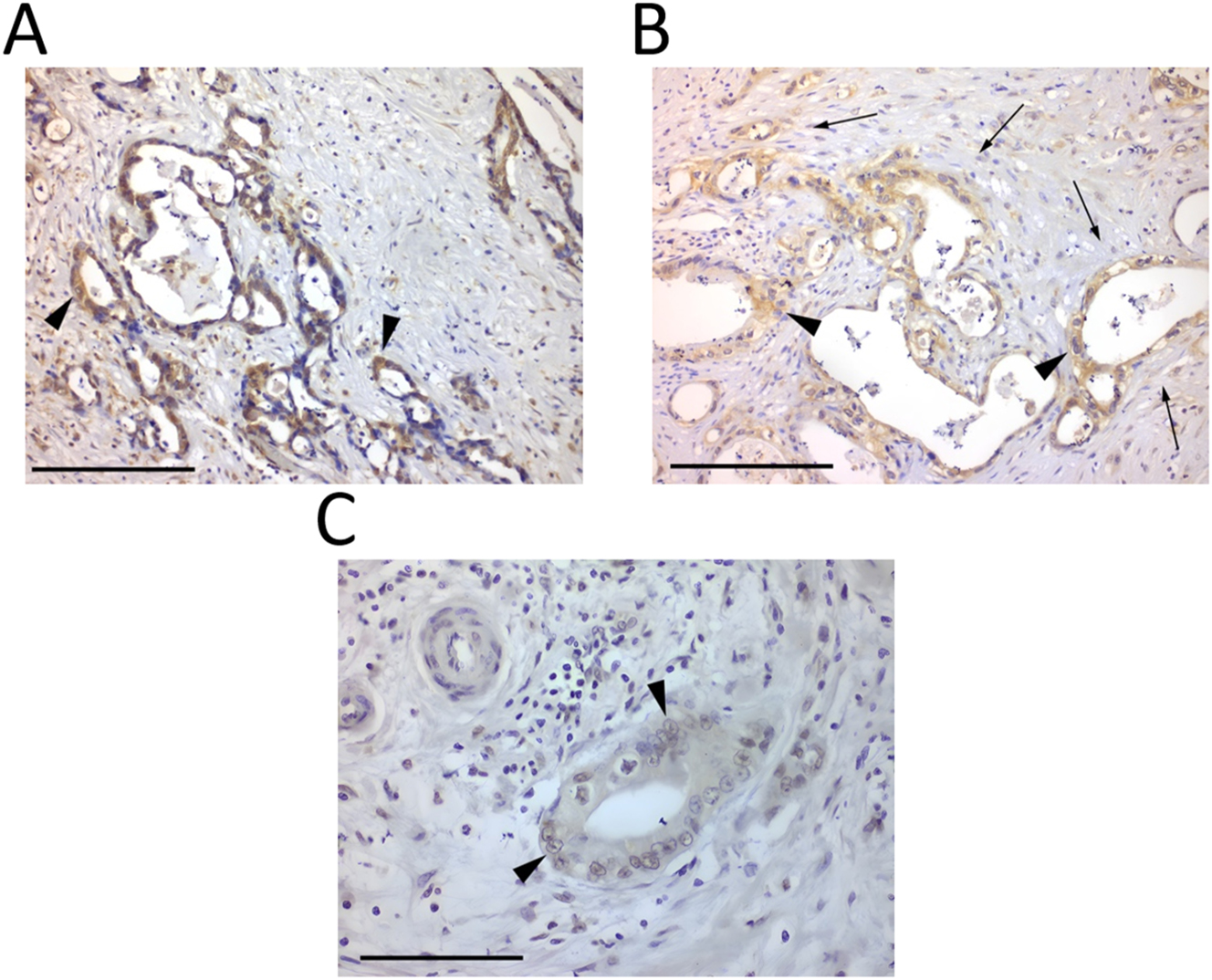 Figure 1: 
Immunohistochemistry images of pancreatic neoplasm tissues. (A) Pancreatic ductal adenocarcinoma demonstrating positive immunostaining for ER-β (black arrowhead at representative stained tumour cells) (×200, scale bar=100 μm). (B) Dense fibroblastic tissue (black arrows) surrounding neoplastic glands (black arrowhead at representative stained tumour cells), positive for ER-β (×200, scale bar=100 μm). (C) ER-β nuclear staining (black arrowhead at representative stained tumour cells) (×400, scale bar=50 μm).
