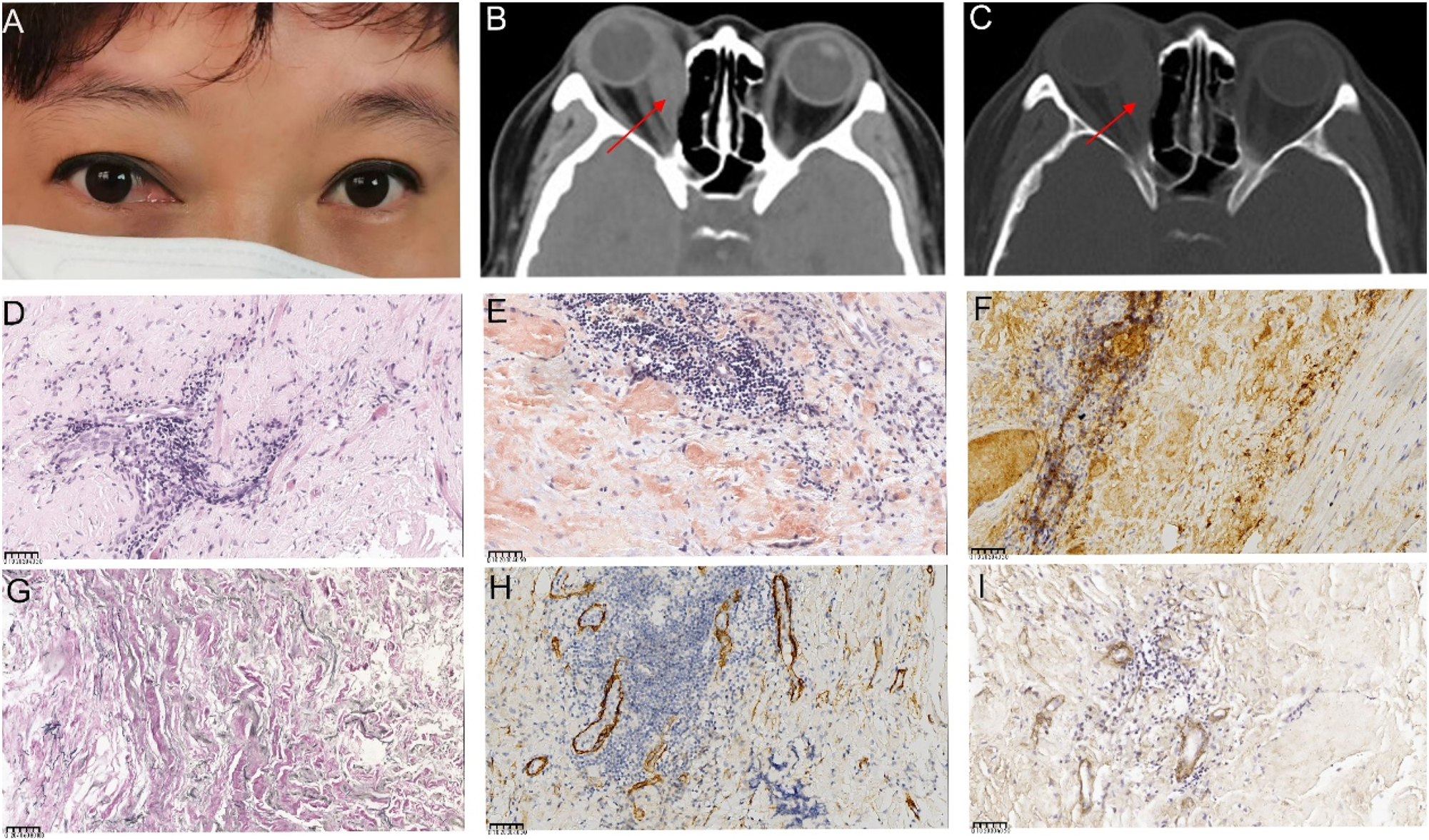 Figure 2: 
Ocular appearance, orbital imaging, and pathological images of the lesion specimen in the first surgery (A) Reoperative image showing proptosis along with congestion and edema of the medial bulbar conjunctiva in the right eye (B, C) computed tomography (CT) images show significant thickening and a clump-like appearance of the right medial rectus muscle, with slight calcification in the lower part. The right ethmoid sinus wall appears compressed and thinned. The red arrows indicate the right enlargement of the medial rectus muscle (D, E) pathological images of the specimen (D) high magnification showing muscle and fibroadipose tissue with interstitial lymphocytic infiltration (hematoxylin and eosin (HE) 400×), (E) Congo red staining of the orbital lesion, demonstrating a positive result under microscopy at 400× (F) HC staining shows over 40 IgG4+cells per high-powered field (HPF) in the lesion (400×) (G) positive elastic fiber immunostaining of lesion cells (200×) (H) Partial positive smooth muscle actin immunostaining of lesion cells (400×) (I) partial positive IV collagen fiber immunostaining of lesion cells (400×). The unit of scale bar is μm.
