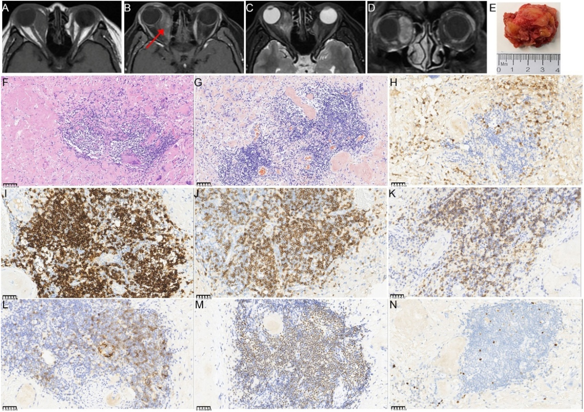 Figure 3: 
The orbital imaging, gross specimen, and pathological images of the lesion specimen in the second surgery (A–D) preoperative enhanced MRI of the orbit before the second surgery. The right retrobulbar lesions appear hyperintense with uneven enhancement on contrast imaging, surrounding the right optic nerve and right eyeball. The red arrows indicate the right enlargement of the medial rectus muscle (E) gross appearance of the resected tumor, which was whitish, hard, and measured approximately 3.5×3×1.5 cm in total volume (F–N) histopathological findings from the second surgery (F) lower magnification showing amyloidosis with a foreign body reaction and focal lymphocyte and plasma cell infiltration (HE; 200×) (G) Congo red staining of the orbital lesion demonstrates a positive result under microscopy at 400×magnification (H) IHC staining for IgG (400×), showing infiltration of a few IgG4-positive plasma cells (I) partial positive CD 20 immunostaining of tumor cells (400×) (J) Partial positive CD3 immunostaining of tumor cells (400×) (K) Partial positive cytoplasmic CD5 immunostaining of tumor cells (400×) (L) A few tumor cells showed positive CD23 immunostaining of tumor cells (400×) (M) Partial positive OCT2 immunostaining of tumor cells (400×) (N) Ki67 immunostaining demonstrates strong nuclear immunoreactivity in approximately 5–10 % of tumor cells (400×). The unit of scale bar is μm.
