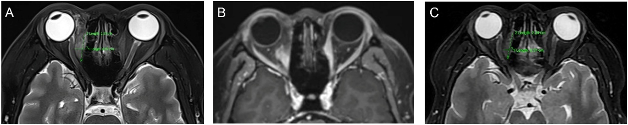 Figure 4: 
Orbital imaging of the lesion after the second surgery (A, B) enhanced MRI of the orbit 2 weeks after the second surgery shows a significant reduction in lesion size compared with the preoperative size. The maximum cross-sectional area of the tumor measured approximately 2.3×0.8 cm (C) Enhanced MRI of the orbit 6 months after radiotherapy, demonstrating further tumor shrinkage, with a maximum cross-sectional area of approximately 2.3×0.57 cm.
