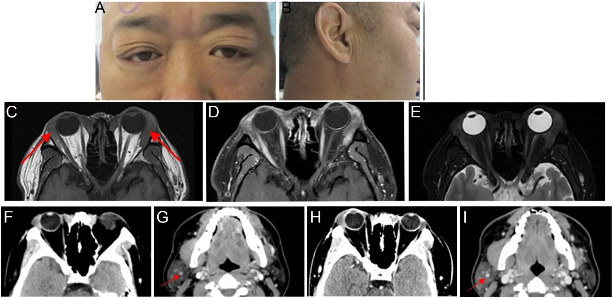 Figure 5: 
Ocular appearance and imaging of the patients (A, B) preoperative images show swelling of the outer upper eyelids bilaterally and enlargement of the right parotid gland (C–E) imaging was performed approximately 2 months before the surgery. The red arrows indicate bilateral enlargement of the lacrimal glands. Orbital MRI revealed bilateral hypertrophy of the lacrimal glands. The bilateral lesions appeared slightly isointense on T1-weighted imaging, with uneven T2 signals and heterogeneous contrast enhancement. The boundary between the lesion and the medial rectus muscle was not clear (F–I) imaging of head CT. The red arrows indicate calcified lesions in the parotid gland (F, G) orbital CT revealed bilateral enlargement of the lacrimal glands, which was more pronounced on the right side. Head CT revealed nodules in the superficial lobe of the right parotid gland, with partial and punctate calcifications in the submandibular gland (H, I) CT scan performed 3 months after discontinuing medication demonstrated that the lesion characteristics remained consistent with previous findings.
