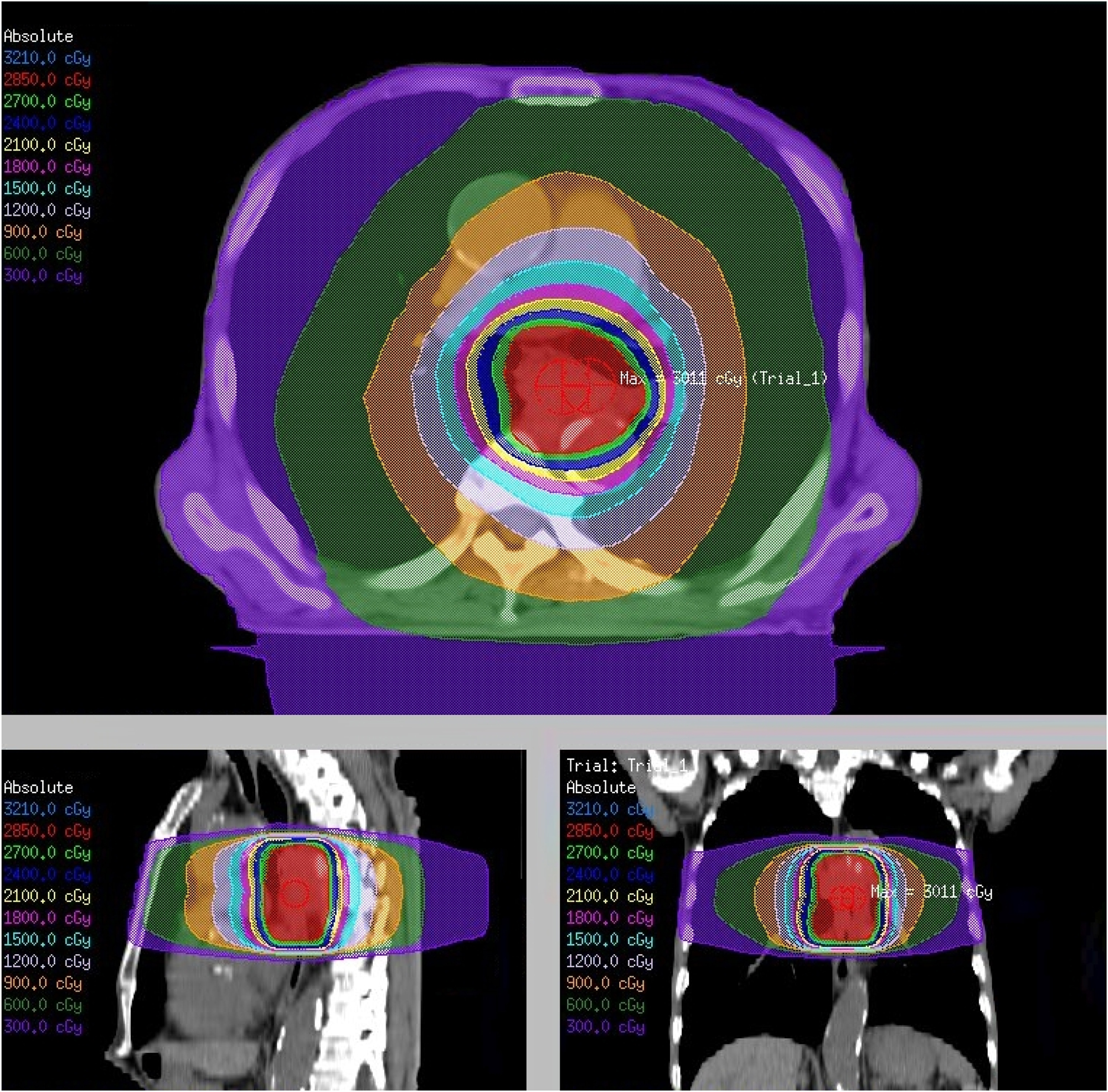 Figure 1: 
Palliative external beam radiotherapy for dysphagia in advanced esophageal cancer. A radiation dose distribution plan for a prescription dose of 30 Gy in 10 fractions. The top image represents an axial cross-section, the bottom left image represents a sagittal section, and the bottom right image represents a coronal section. The color-coded isodose lines indicate different radiation dose levels measured in centigray (cGy). The maximum dose is noted as “Max: 3011 cGy”. This figure is based on the institutional data and treatment planning system and has not been published elsewhere.
