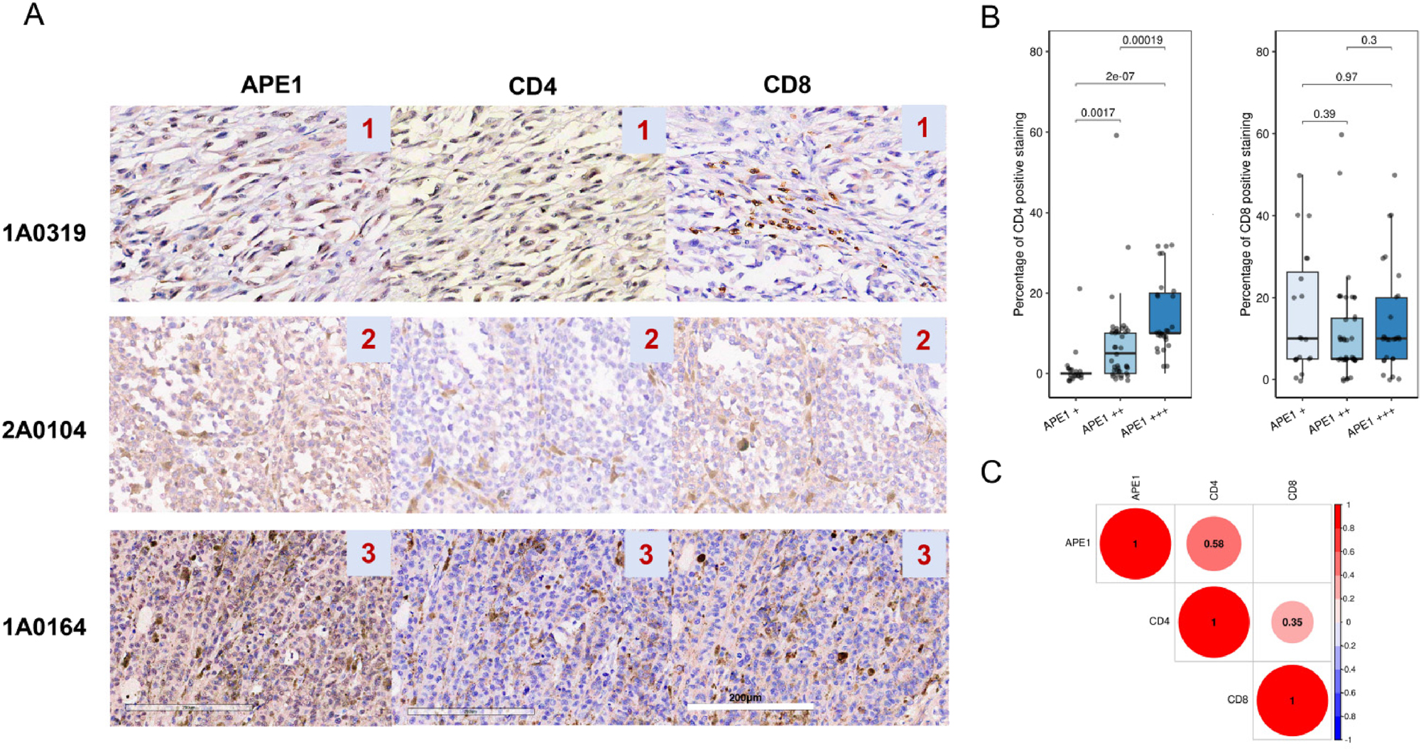 Figure 4: 
APE1 expression levels correlate with CD4+T cell infiltration. (A) representative IHC images of APE1 and TILs infiltration of CD4+, CD8+ cells. (B) boxplots showing the difference in the percentage of CD4+ T cells and CD8+T cells among three APE1 staining density groups. (C) correlation plots of CD4+ T or CD8+ T cells infiltration and APE1 expression. The number values in the colored circles represent the spearman correlation coefficients with significance less than 0.05.

