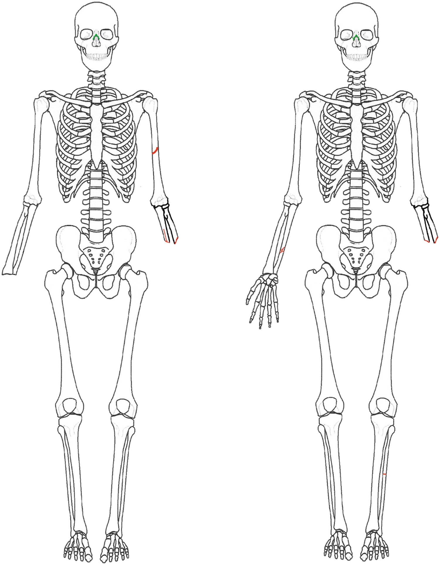 Figure 3 
                     Diagram of skeleton, anterior view. Individual 1♀ and Individual 2♂, respectively. The locations of the lesions are shown in red. Source: this work.