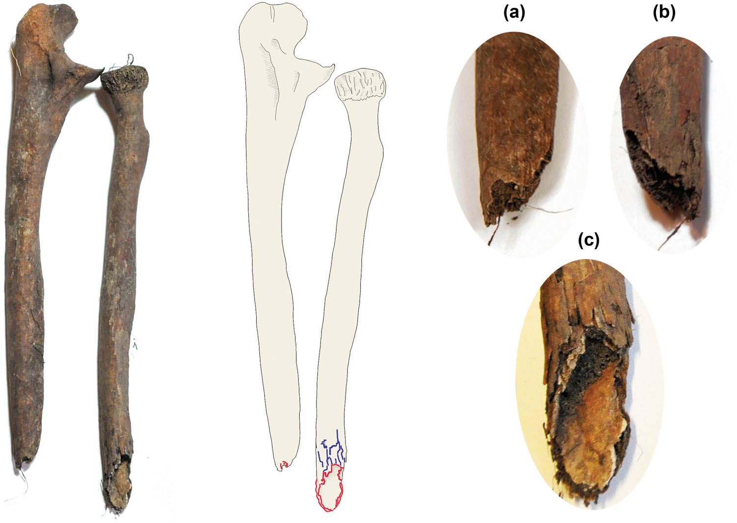 Figure 6 
                     Individual 2♂, lateral view of the ulna and posterior view of the radius. The borders of the fracture are highlighted in red. Peeling of the cortex is observed (in blue the parts magnified by taphonomic effects). (a–c) Show details of bones’ trauma. (a) Medial view of the ulna. (b) Lateral view of the ulna. (c) Posterior view of the radius; the border of the fracture is bevelled at the distal end of the fracture. Source: this work.