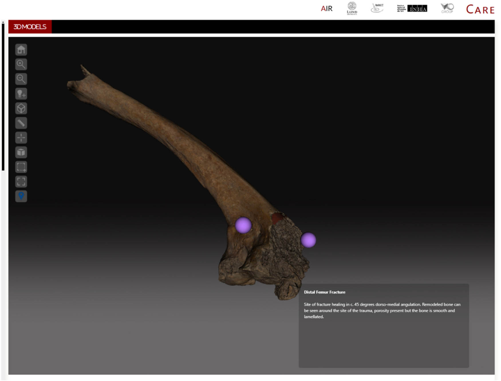 Figure 4 
                     3D Modelled left femur, looking at the distal section. Annotations are visible as purple orbs, and clicking annotations reveal the attached metadata as shown.
                  