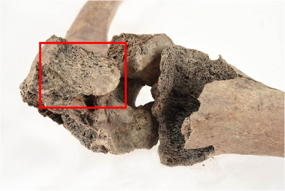 Figure 6 
               Close-up of the left knee with the fused patella visible to the left (red box). Photo: Nelly H Hercberg, Cultural Museum in Lund.
            