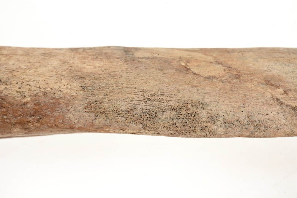 Figure 7 
               Active and healed periosteal new bone growth on the right tibial diaphysis. Photo: Nelly H Hercberg, Cultural Museum in Lund.
            