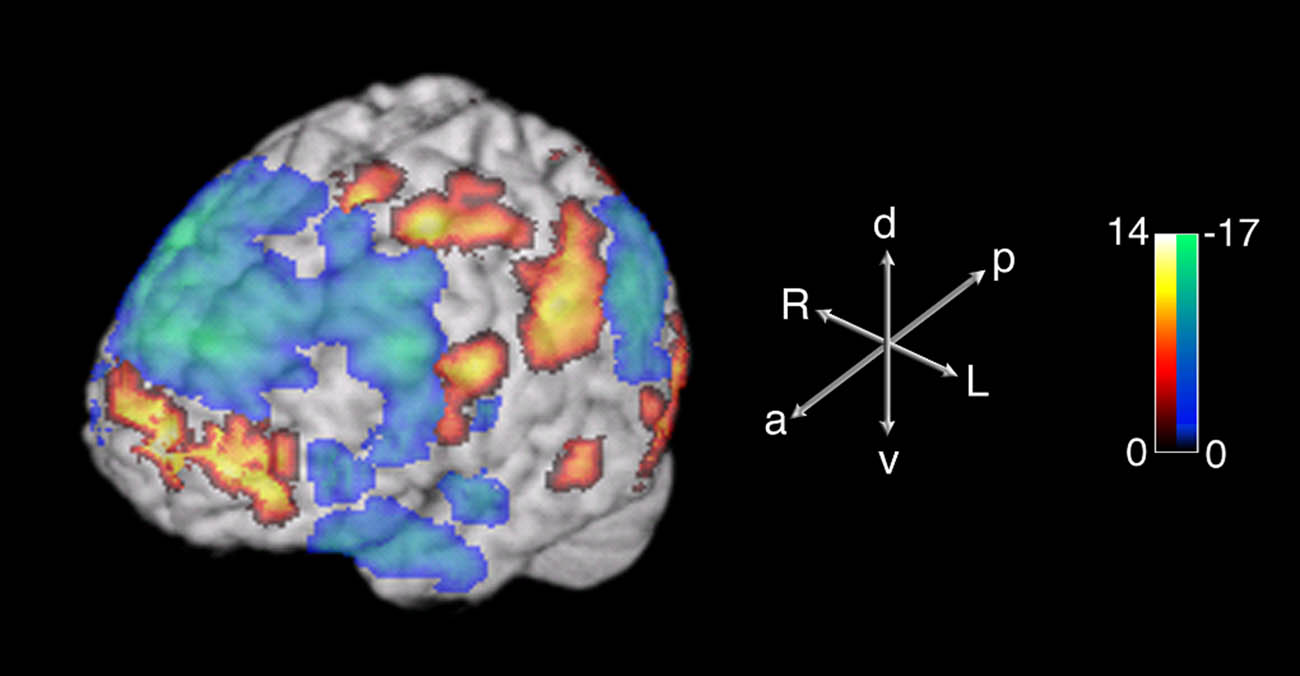 Figure 7
Three-dimensional surface projections of spontaneous activations (red) and deactivations (blue) associated with improvisation during the Jazz paradigm. In: Limb, Charles J., A.R. Braun. “Neural Substrates of Spontaneous Musical Performance: An fMRI Study of Jazz Improvisation.”