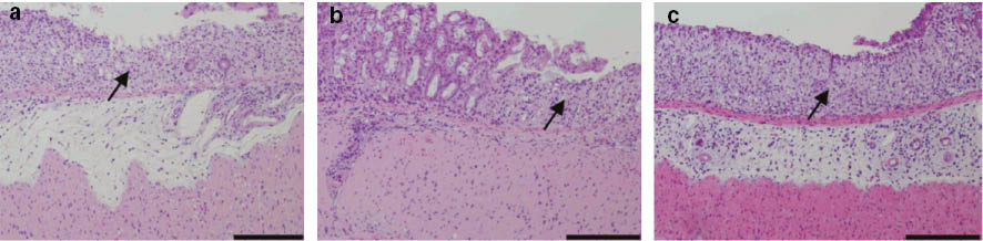 Fig. 5: Effect of administration of chitin nanofibrils on histopathological changes in mice with DSS-induced acute UC.The colon was fixed, and tissue sections were stained with hematoxylin and eosin. Data are presented for one mouse each from the control (a), chitin nanofibrils (b), and chitin-PS (c) groups on day 6. Erosion indicated by arrow. Bar = 100 μm. Reprinted with permission from ref. [26].