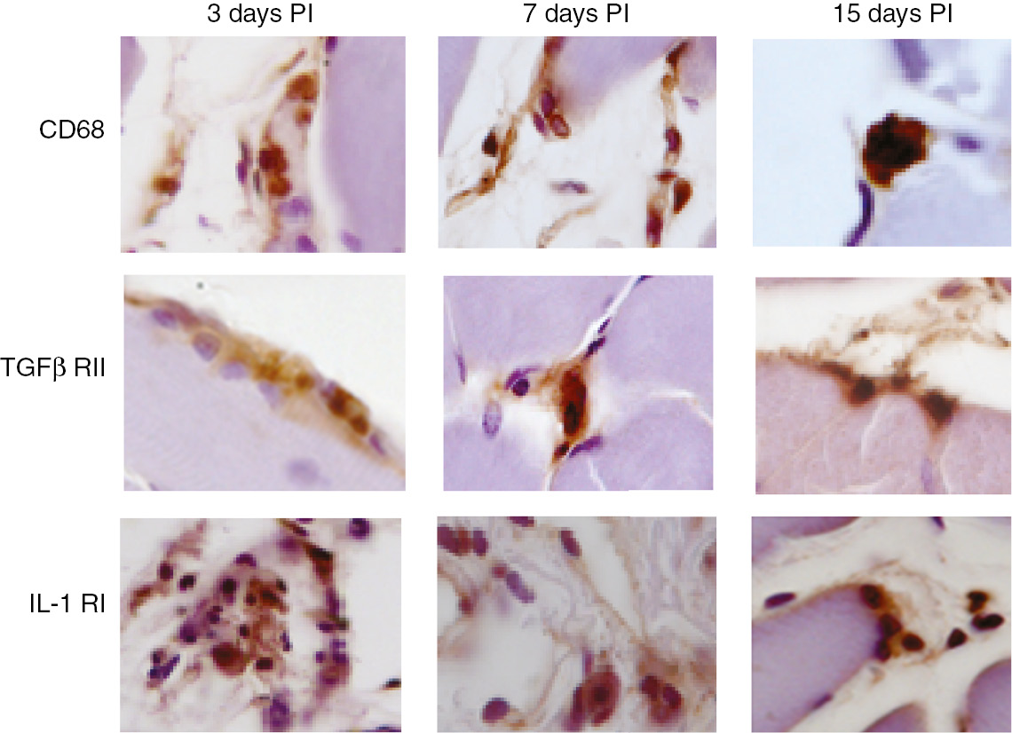 Fig. 3: 
            Recruitment of macrophages and activated fibroblasts and endothelial cells in vivo.
            Light microscope micrographs of anti-CD68, anti-TGFβ RII and anti-IL-1 RI positive cells infiltrated in rat calf muscles inoculated with U937 cells 4 h conditioned medium.
          