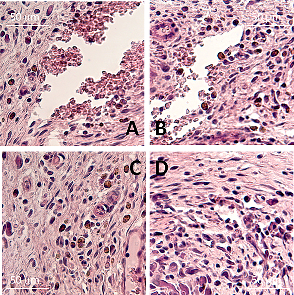 Fig. 12:
Sections of the tissues surrounding the streptokinase-containing films made of polylactide of different molecular mass. The sections were obtained 8 weeks after the subcutaneous implantation of films in rats. Polymers with a molecular weight of 45, 90, and 180 kDa containing 1 or 2% streptokinase were studied. Representative micrographs are presented. a, с – streptokinase-containing polylactide films (1%, 90 kDa), b, d – streptokinase-containing polylactide films (2%, 90 kDa).