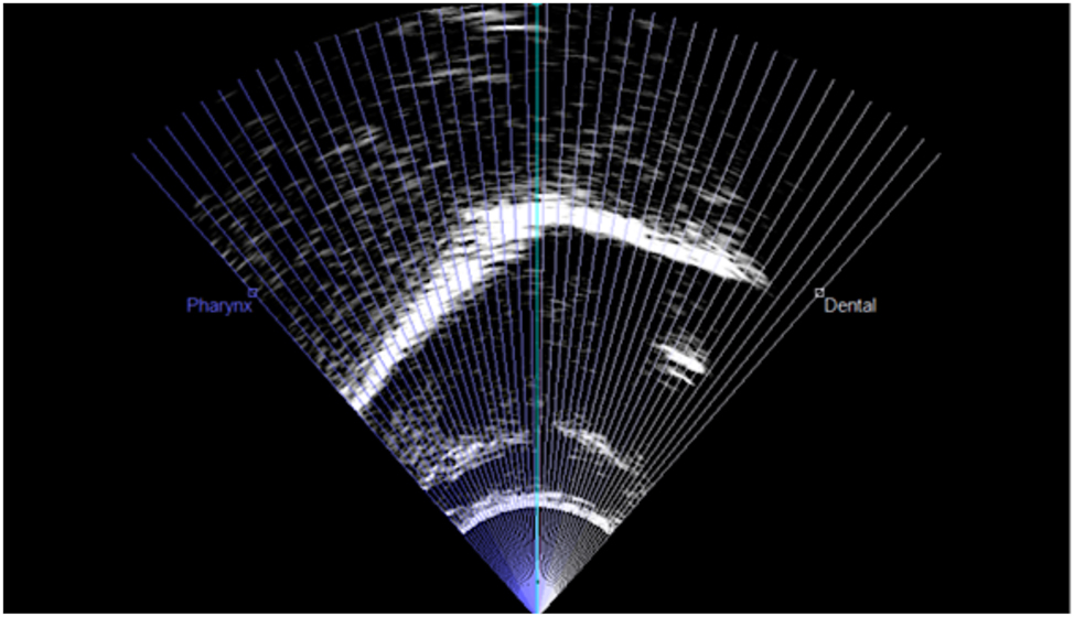 Figure 2:
42 fanpoints and tongue image in a single ultrasound frame extracted from the /l/-realisation in the word pelen produced by speaker SpM5.