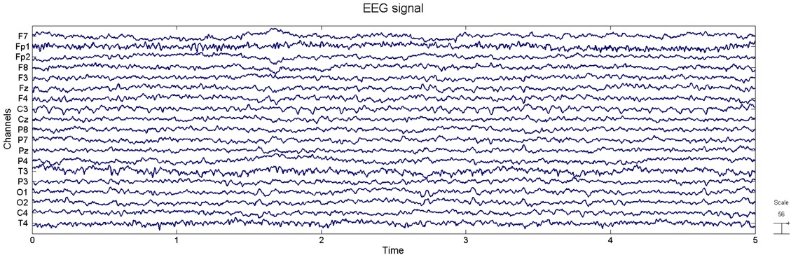 Figure 1 The picture above displays a 5 second EEG signal from a healthy subject sampled at 250 Hz by 19 channels