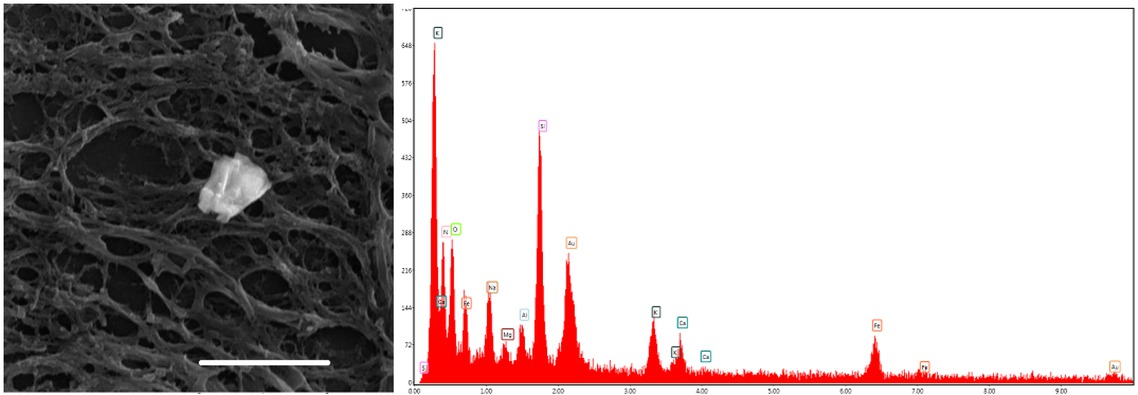 Figure 2 Human brain, globus pallidus. Left – Iron-rich particle. Right – EDX spectrum of this particle showed O, Na, Si, P, S, Cl, K, Ca, Au and Fe. Scale bar = 10 μm. SEM.