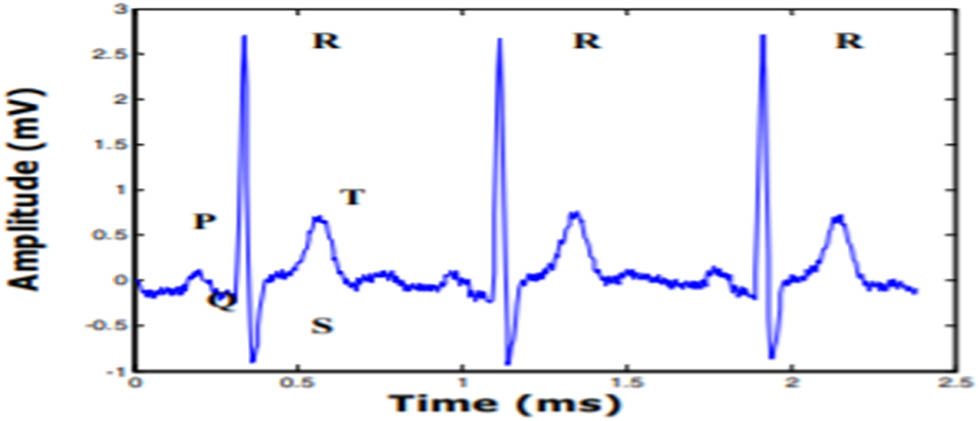 Figure 4 
                  ECG waveform [23].
               