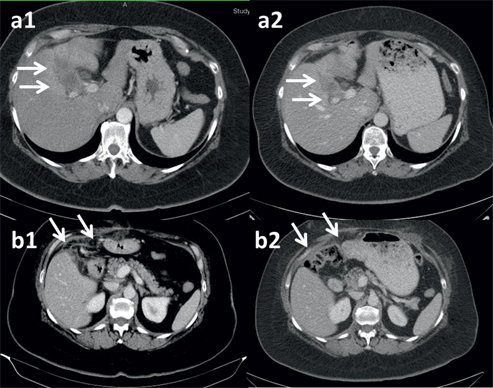 Figure 3: Fifty nine-years old woman with histologically verified peritoneal metastasis of a gallbladder cancer after cholecystectomy.