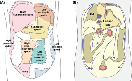 Figure 1: The peritoneal cavity is divided into several anatomic compartments by the ligaments and mesenteries.(A) Peritoneal spaces, organs in place. The supramesocolic compartment is divided into a bilateral subphrenic space and a subhepatic space continuing into the lesser sac. The inframesolic compartment is divided into a left and right region by the mesentery. (B) The movement of fluids within the peritoneal cavity is determined by the peritoneal compartments. Note the large volume and the anatomic boundaries of the lesser sac. Yellow: parietal areas covered with peritoneum. Brown: bare parietal areas. BA: bare area of the right diaphragm. Adapted from Ref. (8).