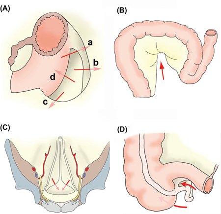 Figure 4: Mesenteries and peritoneal ligaments build into several larger and less pronounced peritoneal cul de sacs (called fossae, recessus and/or fovea).(A) Left paraduodenal recessus, located at the duodenojejunal angle where the duodenum is entering again the peritoneal cavity, and subdivided into: a) the superior duodenal fossa, b) the inferior duodenal fossa, c) the retroduodenal fossa and d) the paraduodenal fossa. (B) The sigmoid recessus is found on the outside of the colon sigmoideum, approximately in its middle (arrow). (C) The supravesical fossae are located between the remnants of the urachus and the left or right umbilical artery. (D) The recessus ileocaecalis superior and inferior are located at the junction of the ileum with the caecum.