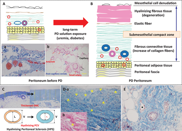 Figure 1: Parietal peritoneum before peritoneal dialysis and hyalinizing peritoneal sclerosis (HPS).(A) Schema for parietal peritoneum before starting peritoneal dialysis (PD); mesothelial cells line on the peritoneum surface. Submesothelial interstitial layer and peritoneal adipose tissue or peritoneal fascia are underlying. (a) Biopsy sample from a chronic kidney disease patient at the beginning of peritoneal dialysis. (b) Peritoneum contains various types of blood vessels classified by the diameter and structure, i. e., small artery, arteriole, post-capillary venule (PCV), and capillary. Submesothelial compact zone (SMC) is defined between mesothelial cell layer surface and the upper border of peritoneal adipose tissue or peritoneal fascia (double arrow). (B) Schema for long-term exposure to PD solution causes thickened SMC with degeneration of the collagen, and hyalinizing vasculopathy with or without narrowing or obstruction of the lumen. (C) Pathological evaluations for SMC thickness and lumen per vessel ratio of PCV. (D-a) Biopsy samples from a long-term PD patient showed thickened SMC that contains homogeneous hyaline change (yellow arrow), (D-b) which is recognized as pink and glassy substance in H&E stain. (E) Hyalinizing vasculopathy is observed mainly in the PCV (*). [A-a, C, D-a, E, Masson’s Trichrome stain; A-b, D-b, H&E stain].