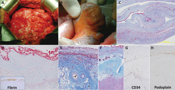 Figure 2: Pathological features of encapsulating peritoneal sclerosis (EPS).(A, B) The encapsulating membrane is a newly formed fibrous membranous structure that covers the visceral surface of the intestines and other abdominal organs. (C) Histologically, the encapsulating membrane is composed of organized deposits of fibrin, along with enlargement and proliferation of peritoneal fibroblasts, inflammatory cell infiltration, angiogenesis and fibrosis. (D) Active fibrin formation was detected on the surface of EPS membrane. (E) Similar pathological components are also revealed in visceral mesothelium such as the greater omentum, and hyalinizing vasculopathy (*)underneath the EPS membrane. (F–H) The EPS case showed hyper-density of blood and lymph vessels in the visceral peritoneum (small intestine). [(C–F) Masson’s Trichrome stain; dot square of (D) Fibrin stain; (G) CD34 stain; (H) Podoplanin stain].
