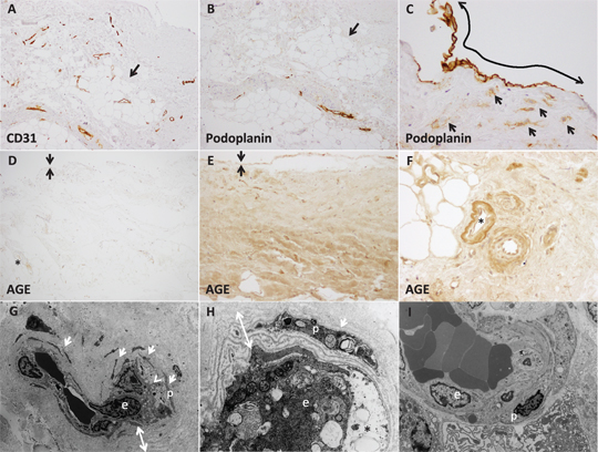 Figure 3: Useful tools for evaluation of PD parietal peritoneum.(A) CD31 staining is used for evaluating blood vessel density. (B) Podoplanin staining showed lymph vessels in the serial section (arrow showed same lesion). (C) Mesothelial cells (double arrow) and fibroblast like cells (arrow) are positive for podoplanin staining. (D, F) Advanced glycation end product (AGE) staining revealed that AGE deposition are more intensive in the long term PD case (E, F) than in a patient before starting PD therapy (D), particularly in the interstitium and vessel walls (black arrows showed mesothelial cell layer, * showed post-capillary venule). (G, H) Transmission electron microscope (TEM) images of parietal peritoneum samples from a PD patient who dominantly used conventional PD solution, and (I) from “biocompatible” neutral PD solution. (G, H) TEM shows severe alterations with lamellar-structure on the basal lamina (double white arrow), and atrophied pericytes (p) (white arrow), on the other hands, the endothelial cell structures (e) are relatively well preserved. Cell vacuolation (v-shaped arrow) and detachment (*) were observed in the conventional PD solution case. (I) The alterations were ameliorated in the patient using more “biocompatible” PD solutions. [The images were taken from parietal peritoneum samples of non-EPS cases. (A) CD31 stain; (B, C) Podoplanin stain; (D-F) CML-AGE stain; (G-H) TEM images,×2.000,×12.000,×2.500, respectively].