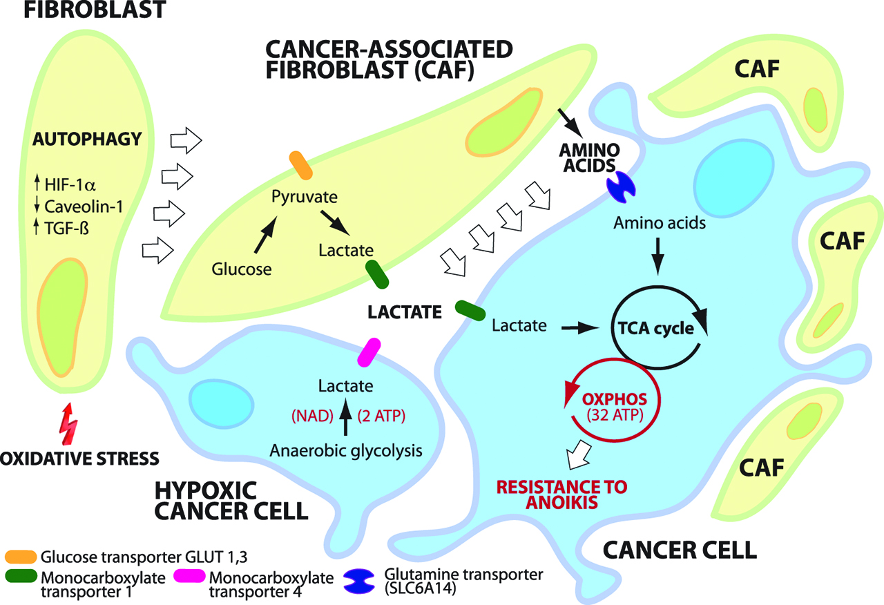 Figure 4: Reverse Warburg effect.Cancer associated fibroblasts (CAFs) form spheroids with cancer cells shed into the peritoneal cavity, forming “Metastatic Units” (MU). Autophagy of fibroblasts provides cancer cells with nutrients and macromolecular building blocks. CAFs support energy metabolism of cancer cells by supplying them with lactate and amino acids. Aerobic glycolysis in cancer cells is more efficient (mitochondrial oxidation: 32 molecules ATP/molecule Glucose; aerobic glycolysis: 4 molecules ATP/molecule Glucose) than anaerobic glycolysis (2 molecules ATP/ molecule Glucose). MU facilitate resistance of cancer cells to anoikis (12).