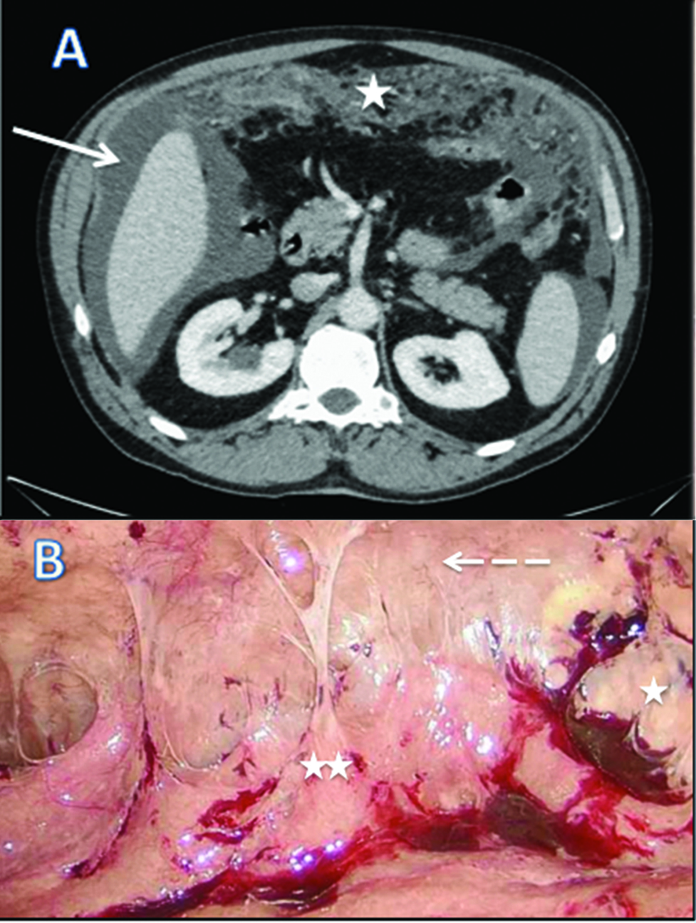 Figure 1: CT scan (A) and laparoscopic evaluation (B) at diagnosis of malignant peritoneal mesothelioma.