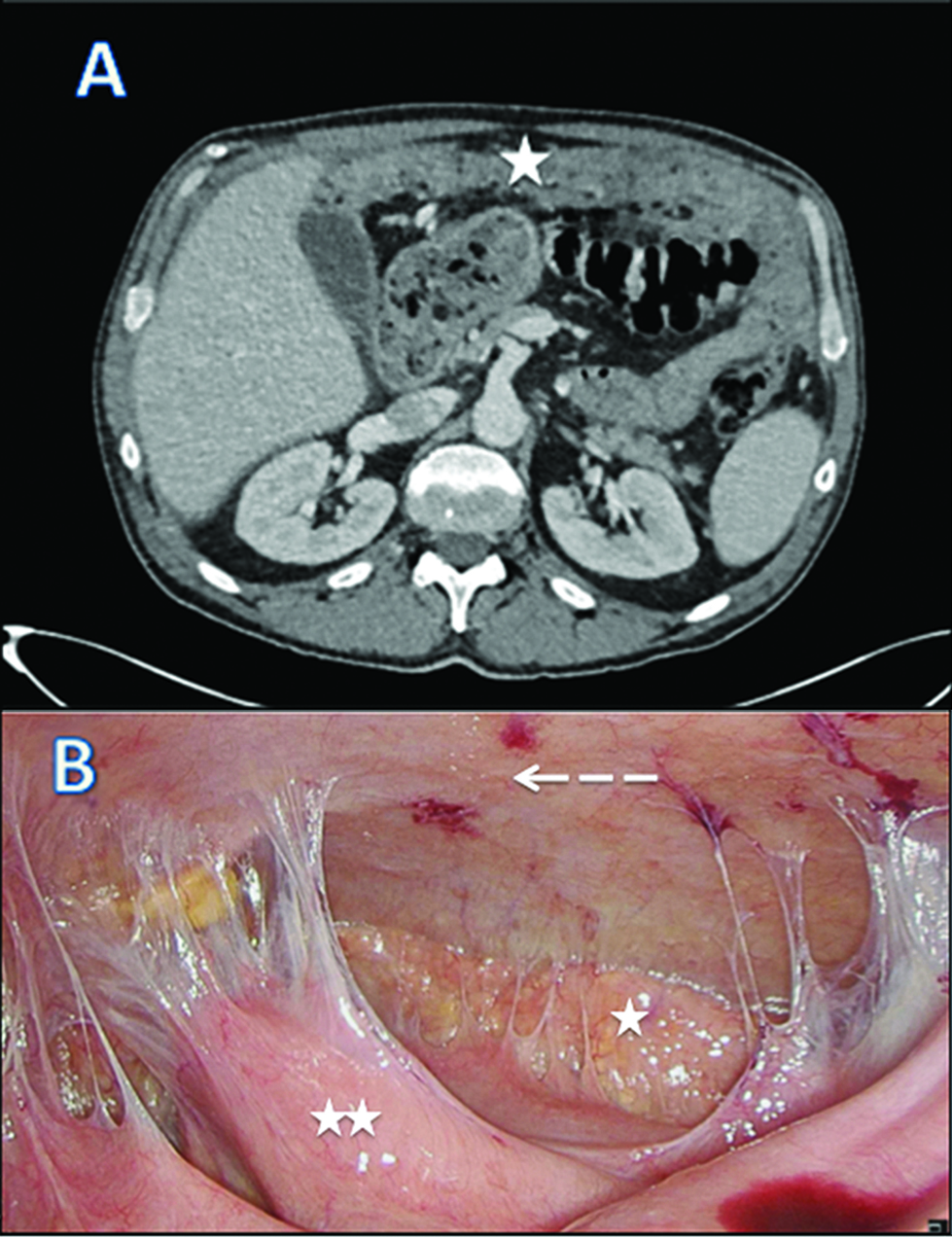 Figure 3: CT scan (A) and laparoscopic evaluation (B) after bi–directional chemotherapy.