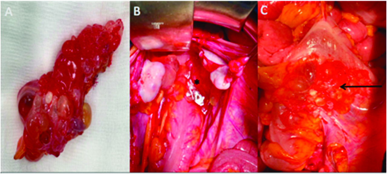 Figure 2: Multicystic mass is composed of multiple translucent cysts gathered in a grape-like form (A), filled with serous fluid, hemorrhagic or gelatinous materials. Multicystic in douglas pouch (star), adherent to the rectum (arrow).