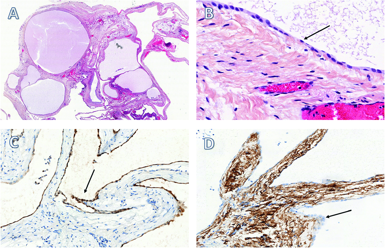 Figure 3: Anatomopathologic aspects of MCPM (x 1) with HES (A). The cystic lesions are lined by a single layer of flattened or cuboidal (arrow) regular mesothelial cells (B). The cells were relatively immunohistochemically positive for calretinin (C) and negative for CD34 (D).
