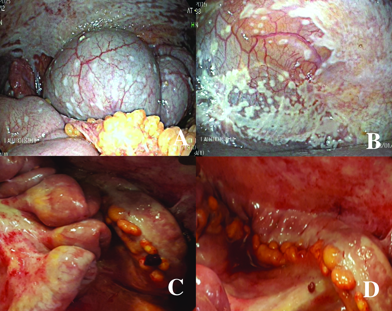 Figure 3: Laparoscopy before and after bidirectional treatment. The first laparoscopy (upper) for staging shows the peritoneal metastases in the right subphrenic peritoneum (left, A) and the pelvis (right, B). The second laparoscopy (lower), after bidirectional treatment, shows the major response of peritoneal metastases in the small bowel (left, C) and in the left parietal peritoneum (right, D). Directed biopsies in the parietal peritoneum (D) showed a major histological response (peritoneal regression grading score (PRGS) 2, major regression features, few residual tumour cells). Figures C and D show chemical peritonitis due to the effects of direct contact with intraperitoneal chemotherapy during laparoscopy.