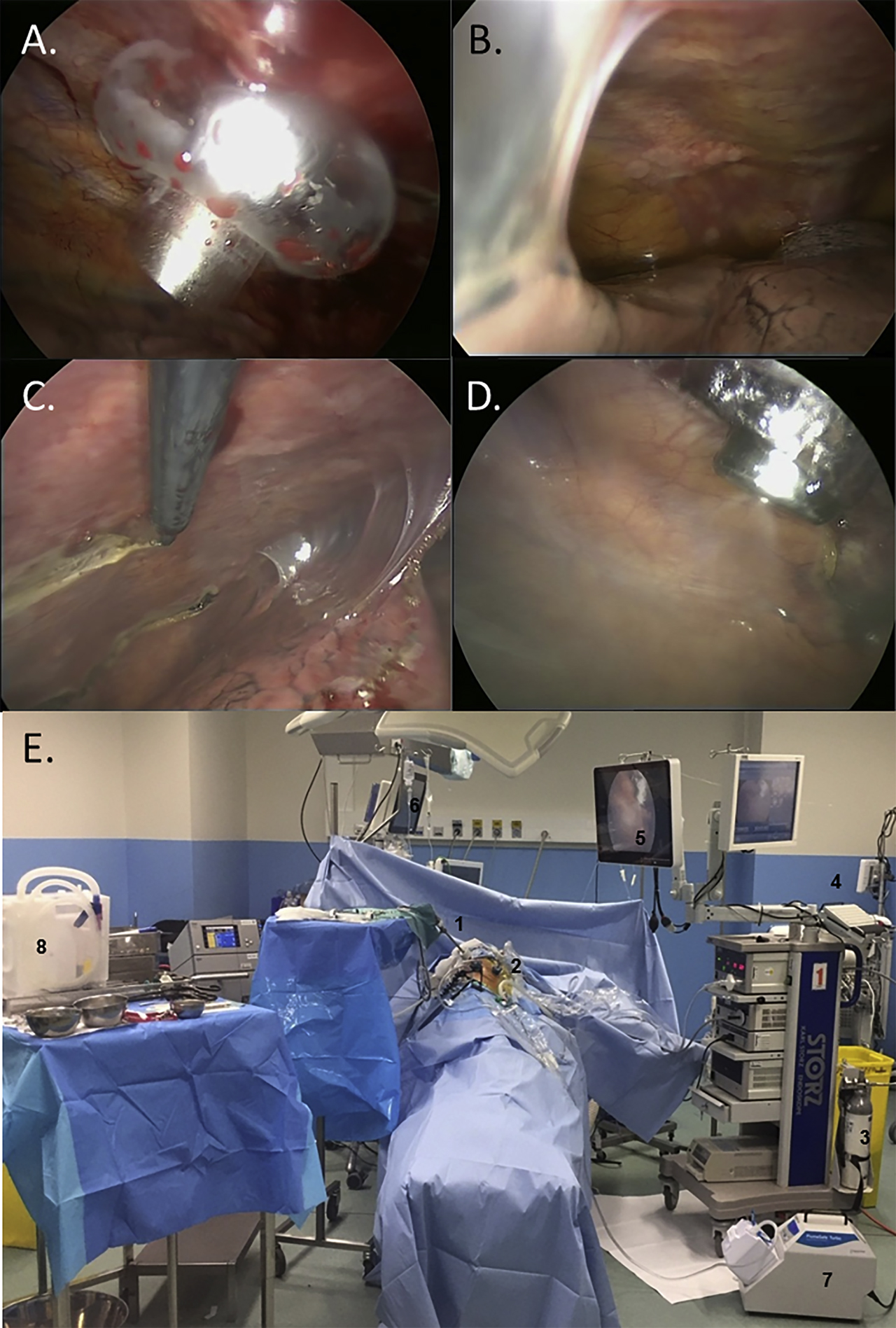 Figure 1: Peroperative intrathoracic views.(A) 12-mm balloon trocar insertion. (B) Pleural cavity exploration showing diffuse pleural nodules, multiple pleuro-pulmonary adhesions, and moderate pleural effusion. (C) Representative pleural biopsy. (D) Real-time endoscopic monitoring of the nebulization, controlling the correct position of the nebulizer and the absence of contact with the lung. (E) Operating room during nebulization. The patient is left alone with remote monitoring of vital signs and nebulization on respective screens. 1. Videomonitoring. 2. Nebulizer. 3. CO2 insufflator. 4. High pressure chemotherapy injector. 5. Screen monitoring the nebulization. 6. Screen monitoring the vital signs. 7. Closed aerosol evacuation system. 8. Material prepared for chest tube insertion and wound closure after aerosol evacuation.