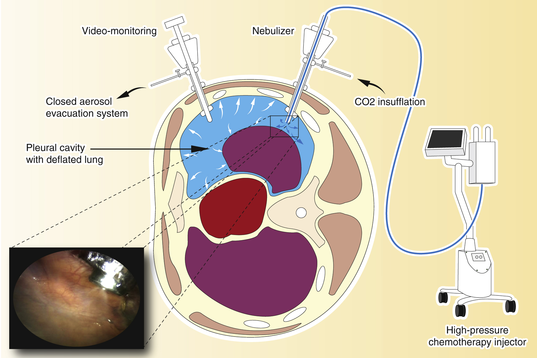 Figure 2: Pressurized intrathoracic chemotherapy (PITAC).The procedure is performed in an operating room equipped with an advanced air filtering system. A balloon trocar is inserted and the camera is introduced to explore the pleural cavity. A second balloon trocar is inserted, permitting pleural effusion removal, pleural biopsies, and finally, the placement of the nebulizer. An intra-thoracic pressure of 12 mmHg CO2 is established, and the chemotherapy is aerosolized over a period of 6 min. The system is maintained in steady-state for 30 min. At the end of the procedure, the toxic aerosol is exhausted through a closed aerosol evacuation system (CAWS).