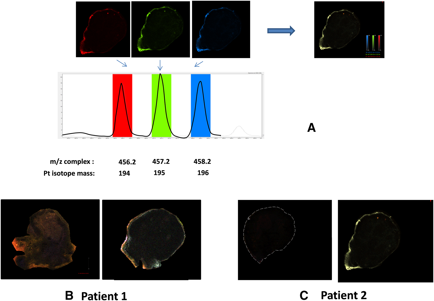 Figure 1: MALDI-MS images.(A) Identification by MALDI mass spectrum of isotope-specific platinum compounds in tissues at m/z 456.2, 457.2, and 458.2, which correspond to platinum isotopes 194, 195, and 196. The presence of platinum is demonstrated by the exact co-localization of the masses of the three signals from each platinum isotope as illustrated by the merged resulting picture (right panel). Panels (B) and (C): localization of an oxaliplatin complex in a slice of ovaries from patients P1 and P2 before (left) and after HIPEC (right).